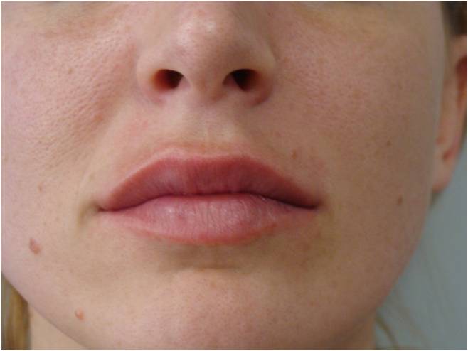 Restylane 1 mL